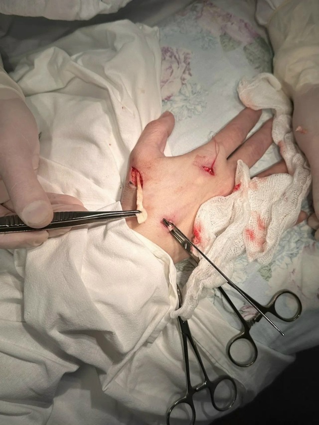 В Башкирии сделали уникальную операцию на кисти