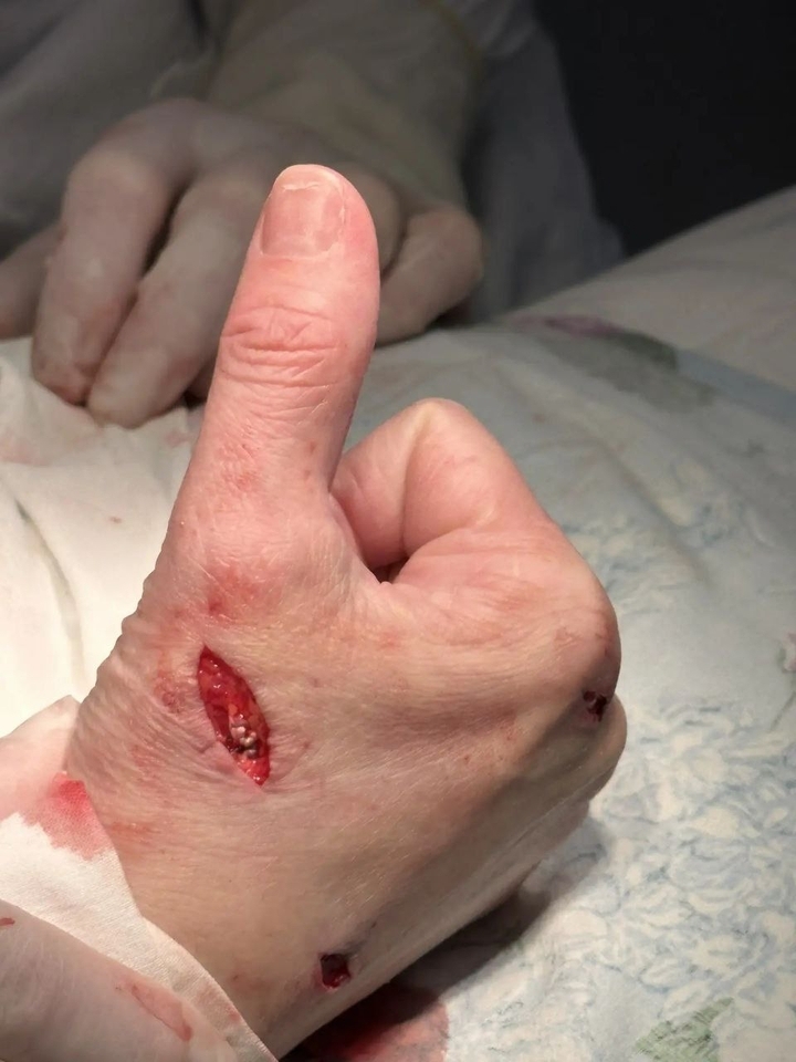 В Башкирии сделали уникальную операцию на кисти